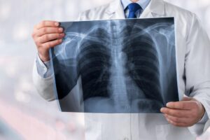 空污是关键?夫妻先后确诊肺癌 医师:早期无症状,4大高危险群定期检查