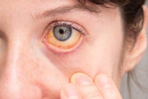 小心! 这样的你 ! 肝癌风险恐增150倍！