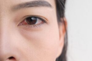 “皮蛇”可能长在眼睛!医师:严重恐失明,出现2症状是重要警讯