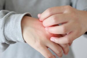 湿疹痒到睡不着？中医师四招远离汗疱疹、皮肤痒，这3种水果记得少吃