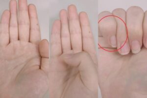 主动脉剥离致死率高,医教一招自我检测是否为高危险群