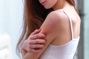 湿疹皮肤痒、起疹子超难耐!中医提醒避免湿疹爆发内外除湿不可少