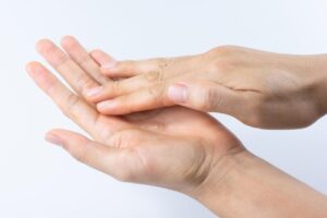 手起水泡红肿、反复搔痒脱皮,富贵手是内在发炎!中医:抓紧6要点降低复发率