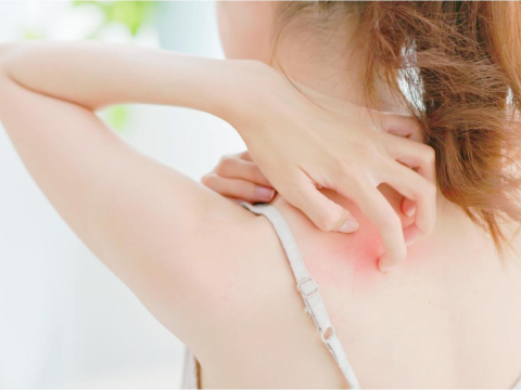 只要一被蚊虫咬，就会出现红疹子、过敏不适症状！皮肤科医师详解6种预防和治疗方法 – 大保社