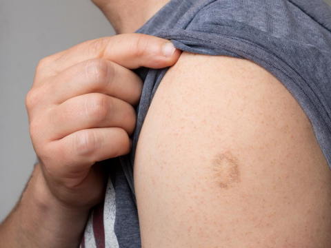 中国台湾“猴痘”首例出现！会人传人？有哪些症状？如何预防？5大QA一次看懂 – 大保社