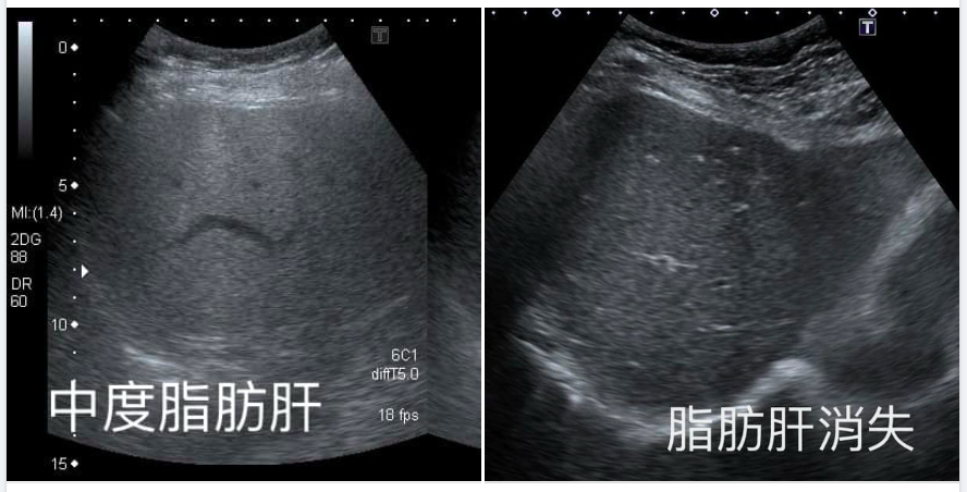 只花一年消除中度脂肪肝!不是运动,她60岁“改变一个习惯”狂瘦10公斤,医师惊“肝脏颜色变深了” – 大保社