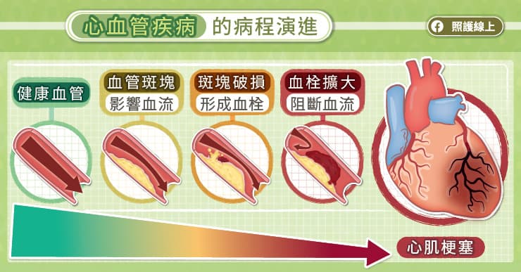 胃不舒服、胸痛，恐是心肌梗塞！它容易复发，救命后要长期保养，心脏医师图解说明 – 大保社