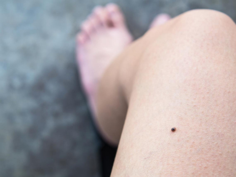 常见皮肤癌有3种，“恶性黑色素瘤”致死率最高！医曝5种痣恐是癌，长在“这一处”最危险 – 大保社