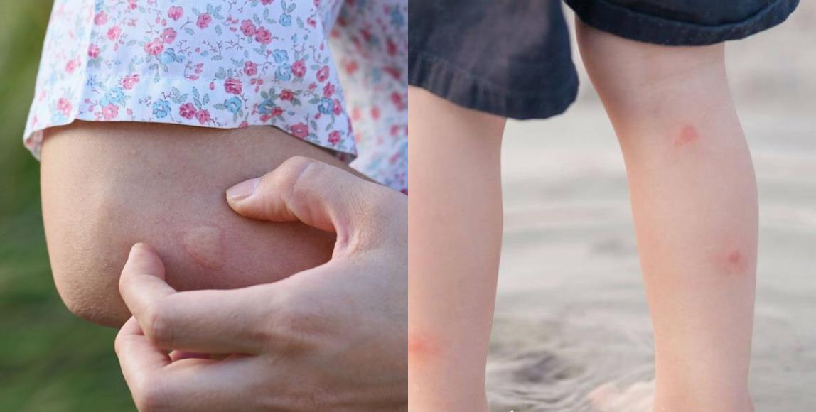 香茅、樟脑真的可以驱蚊?防蚊液又该怎么选? 内容图2 女神网-大潮社TV实时追踪属于女人新资讯的综合网站! 香茅、樟脑真的可以驱蚊?防蚊液又该怎么选? 健康养生 图2张