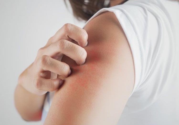 大热天皮肤超容易冒疹子!6 种方法改善皮肤状况:饮食清淡、尽量少穿紧身牛仔裤 内容图2 女神网-大潮社TV实时追踪属于女人新资讯的综合网站! S__24477706