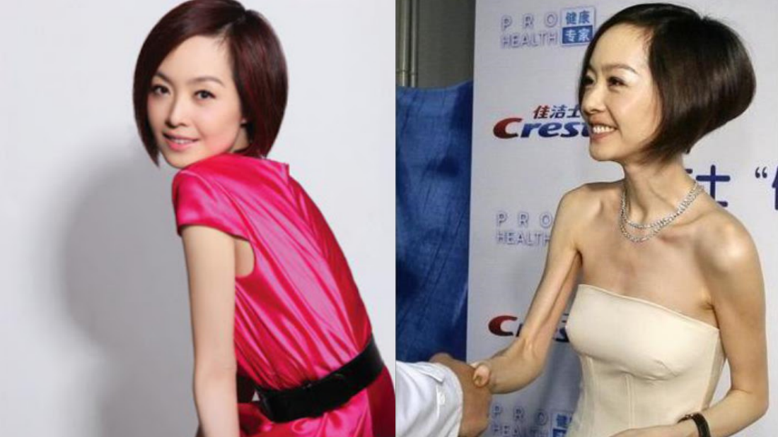 瘦未必漂亮！10位暴瘦女艺人 对比照太恐怖了！ 娱乐资讯 图10张
