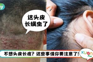Tips I 头皮长痘痘也属于皮肤问题？5大原因你可能忽视了！