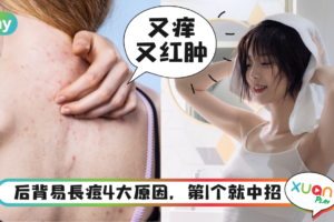 Tips｜后背痘痘“满天星”怎么办？4招灭痘法必须懂！
