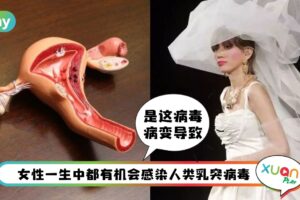 健康 I 梅艳芳因它逝世！揭患子宫颈癌4前兆