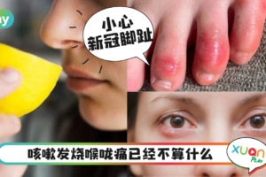 Tips｜现在还有“新冠脚趾”？新冠肺炎3大隐形症状要注意！