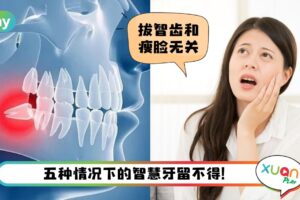 Tips I 智慧牙跟长智慧无关！5种情况下牙医都会建议拔掉它们
