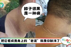健康 I 脖子后面黑黑不是脏而是病！患上黑棘皮症的3大原因