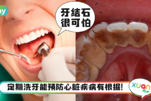 生活|洗牙到底是不是“智商税”?关于洗牙的3大好处和3大误区!