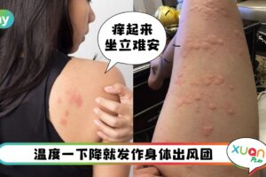 食谱 I 下雨天导致“寒冷性荨麻疹”发作！这道疏风散寒汤能舒缓