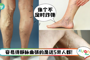 生活｜久坐引发静脉曲张，上班族该如何摆脱“蚯蚓腿”？