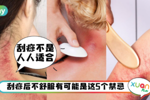 Tips｜刮痧虽然爽但有5禁忌要注意，小心惹细菌上身！