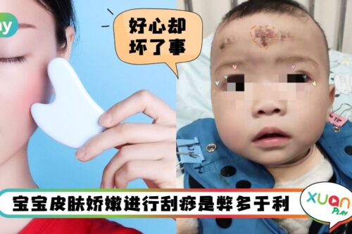 Tips I 10个月婴儿刮痧刮到面部溃烂！脸部刮痧要注意的事项