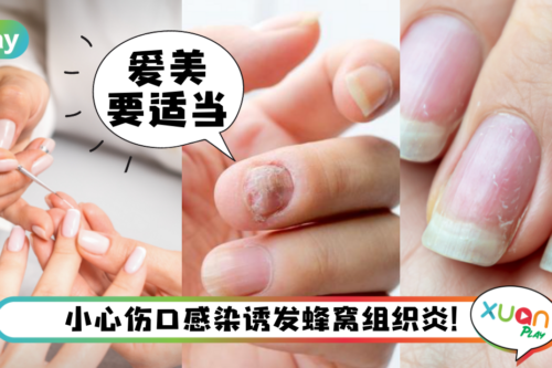 生活｜网红做美甲手指遭细菌感染需截肢，医提醒美甲有这3风险