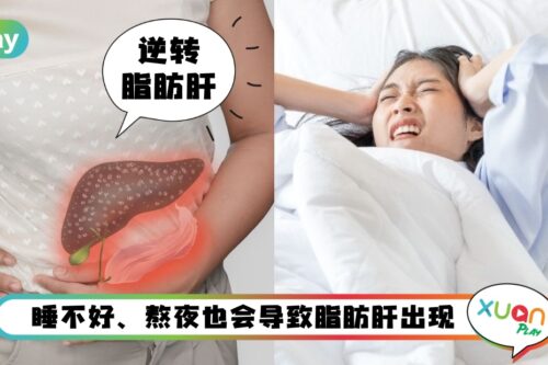 健康 I 脂肪肝不请自来？4招改变饮食将“它”送走