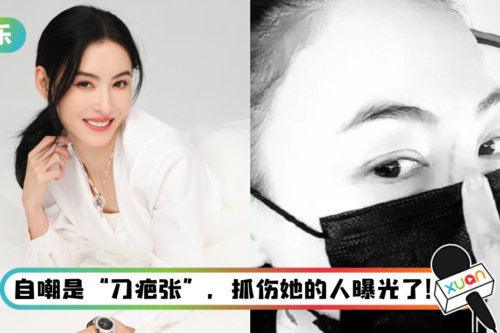 张柏芝脸受伤险破相！ 眉心到鼻梁超长一道疤