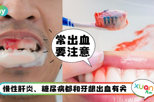 Tips｜牙龈突然出血要小心，除了牙周病还可能是肝生病！