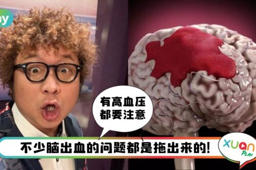 健康 I 纳豆脑出血插管抢救！脑出血8种信号越早发现越保命