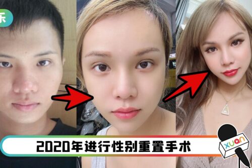 网红5年整容11次！截断肋骨打造蚂蚁腰！