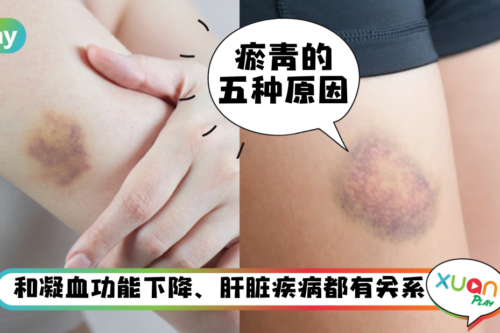 生活｜你也是易“黑青”体质？无缘无故黑一块要小心是疾病！