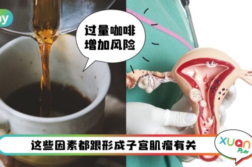 Tips I 预防子宫肌瘤增大和复发,这6大因素要把关好!