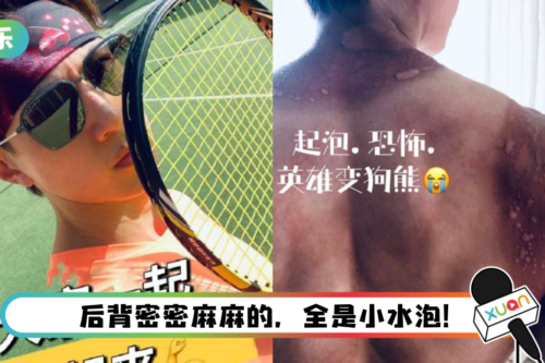 吴尊打球晒伤！ 脖子脱皮、后背起三大片水泡