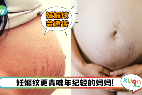 生活 | 90%孕妇的困扰！3大方法减少妊娠纹 不花钱也能解决！
