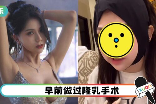 蕾菈动抽脂手术！“脸肿成猪头”维持1个月！