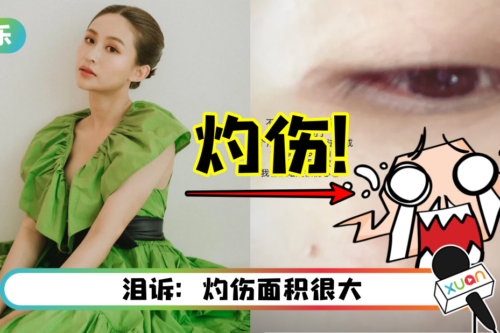 Ribbon 黄若熙脸部灼伤!严重到无法上妆…工作急喊卡