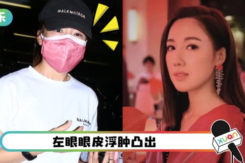 李施嬅免疫系统出事！“大小眼”抱病现身！