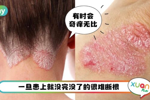 Tips I 最难断根的皮肤病！如何防止牛皮藓复发的6个建议