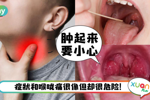 健康｜以为喉咙痛其实是扁桃腺炎！严重会窒息、需开刀切除！