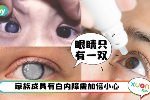 健康｜天啊！还以为长期晒太阳只会变黑，原来还会晒出白内障？