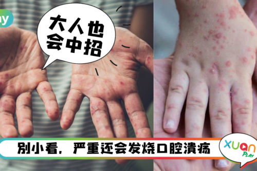 健康｜马来西亚儿童手足口症暴增12.8倍，这两类人小心也会中招！