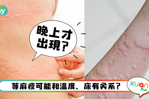 生活｜荨麻疹只会在晚上出现？那是因为这3个原因导致！