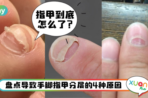 健康｜指甲出现分层是怎么一回事？爱运动的人也常中招？