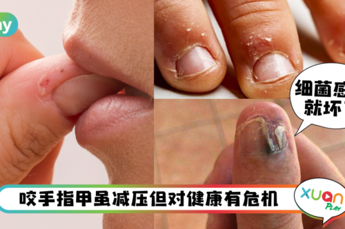 健康｜咬手指导致要截肢？这5个恐怖结果不能不懂！