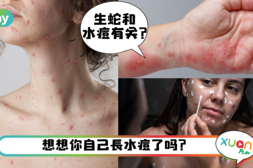 科普 ｜为何水痘要叫Chickenpox，难道真的和鸡有关系？