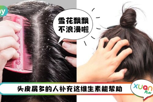 Tips I 治疗头皮屑吃这个维生素最见效！3招让你摆脱头皮屑烦恼
