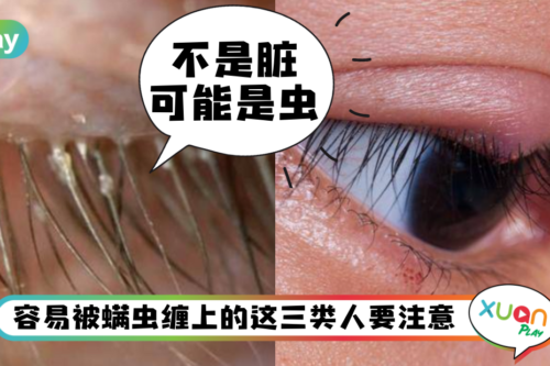 健康｜总是长针眼、眼睛发痒？可能是睫毛里的螨虫在作怪！