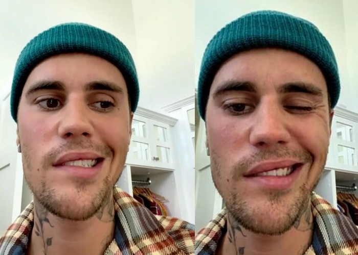 健康｜翻白眼、嘴巴合不拢，Justin Bieber患这罕见带状孢疹并发症！ 更多热点 图2张